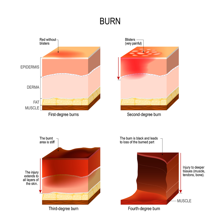 Impact of Hyperglycemia in Burn Trauma